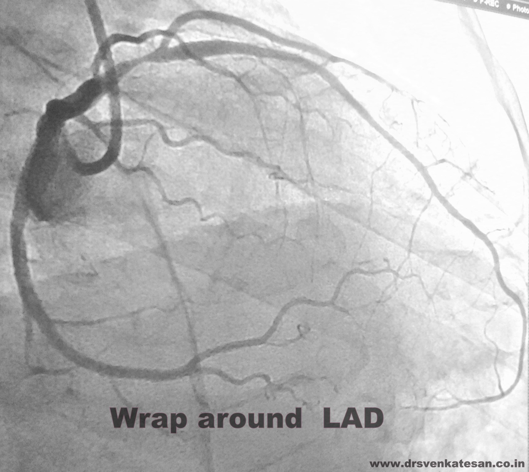 1718x1533 lad ekg drawing pictures and ideas on meta networks - Ekg Drawing