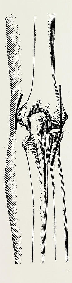231x900 excision the elbow is now extended, medical equipment drawing - Elbow Drawing