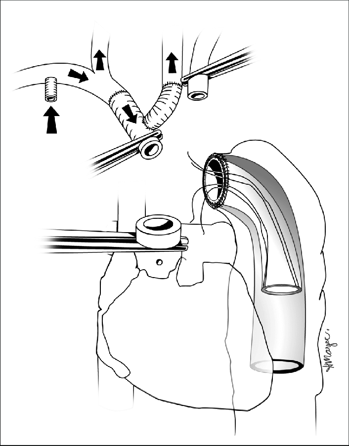 706x903 Schematic Drawing Of Elephant Trunk Graft In Situ Download - Elephant Trunk Drawing