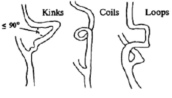 658x376 figure from arterial elongation is not a feature - Elongation Drawing