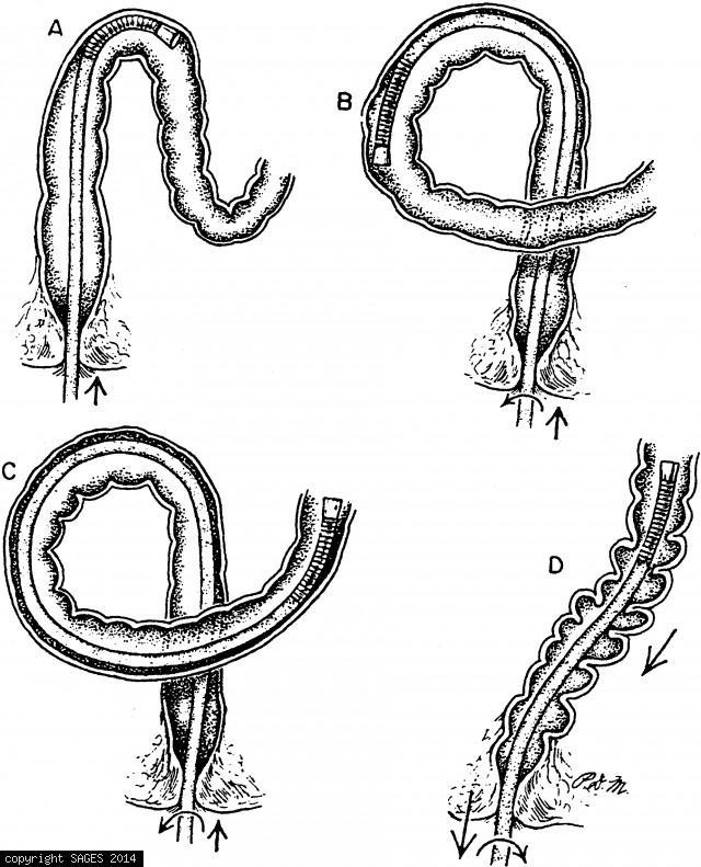 640x791 Intubation - Elongation Drawing