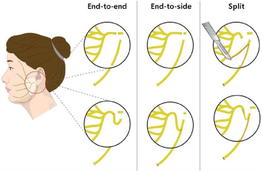 850x557 Schematic Drawings Of The End To End, End To Side, And Split - End Drawinging