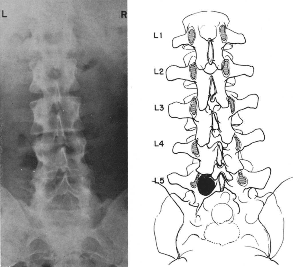 1024x933 Punched Out Erosion Of Lamina - Erosion Drawing