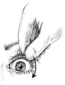 221x288 foreign body in the eye children's hospital colorado - Eyelid Drawing