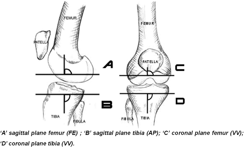 850x513 Schematic Drawing Of The Cutting Planes Of The Distal Femur - Femur Drawing