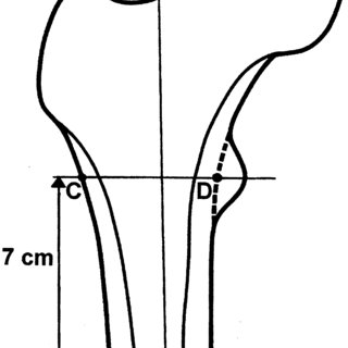 320x320 Schmematic Drawing Of The Proximal Femur The Morphological - Femur Drawing