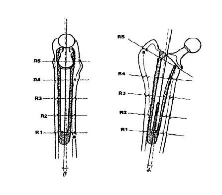 446x391 Template Of The Femur With Implanted Prosthesis Schematic Drawing - Femur Drawing