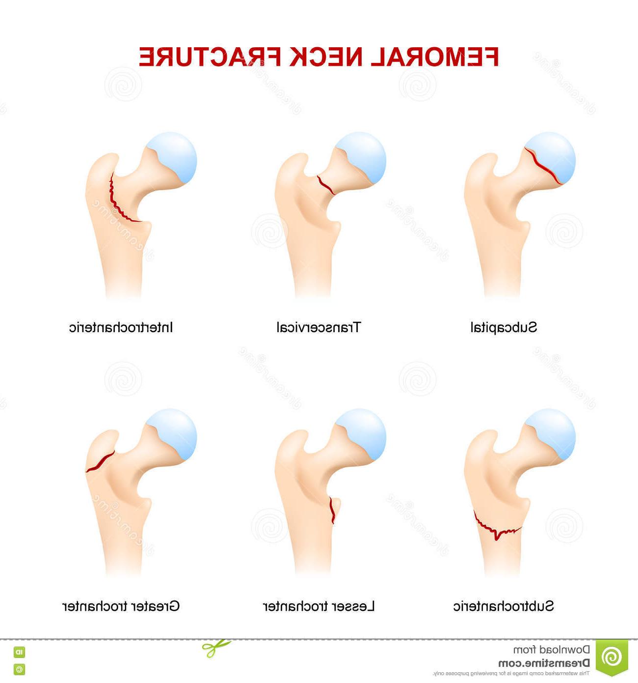 1300x1390 top fracture neck femur femoral major types drawing - Femur Drawing