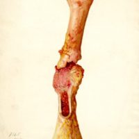 200x200 colored drawing of fractured femur with cancerous growth onview - Femur Drawing