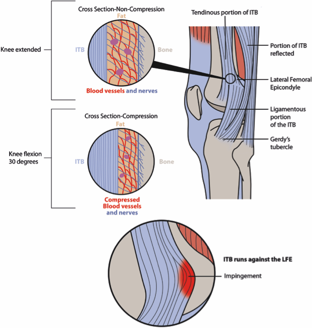 618x651 illiotibial band syndrome compression or friction - Friction In A Bone Joint Vector Drawing