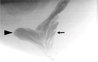 384x243 a mesh free solid mechanics approach for simulating the friction - Friction In A Bone Joint Vector Drawing