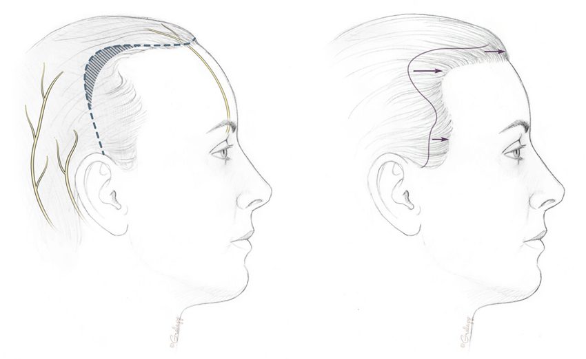 850x522 hairline lowering - Hairline Drawing