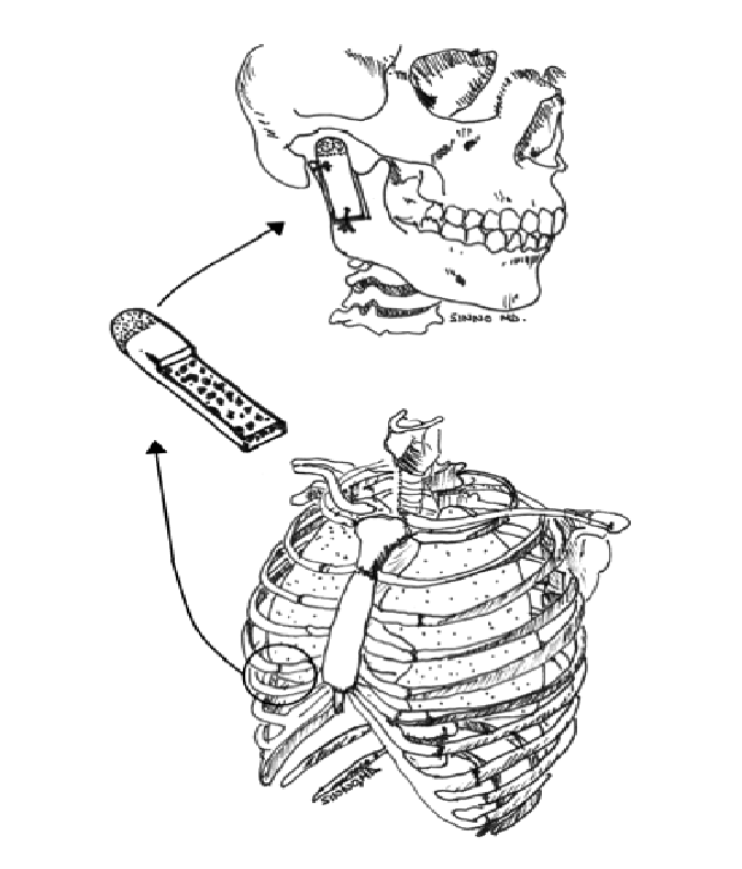 675x790 drawing of the harvest of the costochondral rib graft - Harvest Drawing