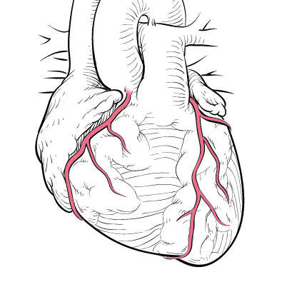 402x402 What Is Cad Heart Care Intermountain Healthcare - Heart Disease Drawing