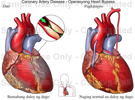 Heart Disease Drawing at PaintingValley.com | Explore collection of ...