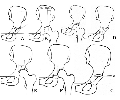 492x411 Schematic Drawing Of The Hip Joint Showing Sharp's Acetabular - Hip Drawing