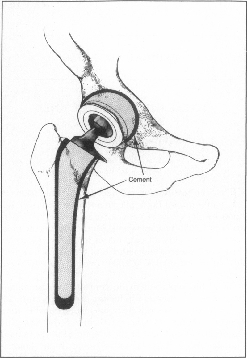 800x1158 Total Hip And Total Knee Replacement Nejm - Hip Drawing