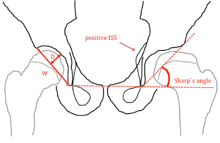 714x465 Drawing Of An Antero Posterior - Hip Drawing