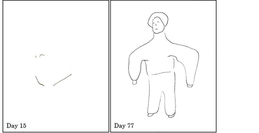 850x436 Drawing Of A Human Body The Patient's Drawing Days After - Human Body Line Drawing