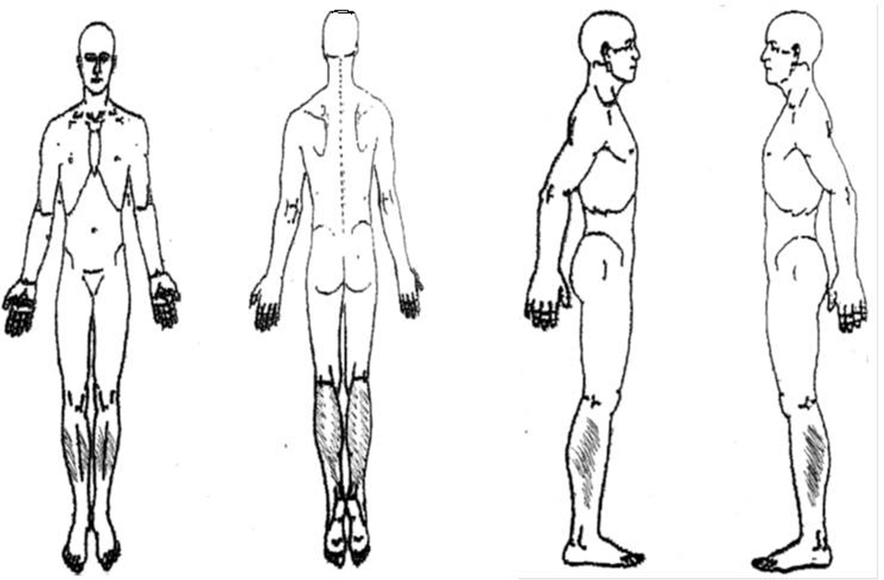 1800x1182 Patient Pain Drawing Is A Valuable Instrument In Assessing - Human Leg Drawing