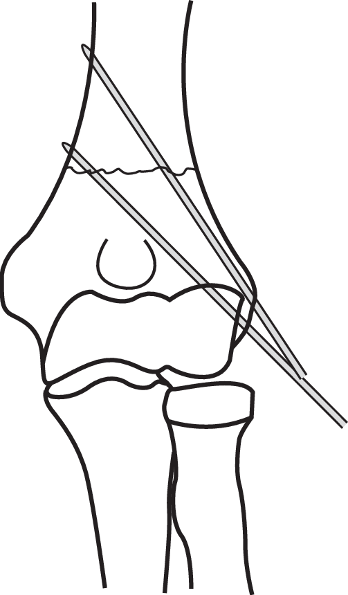 503x860 Step Coronal Line Drawing Demonstrating Ideal Divergent Lateral - Ideal Drawing
