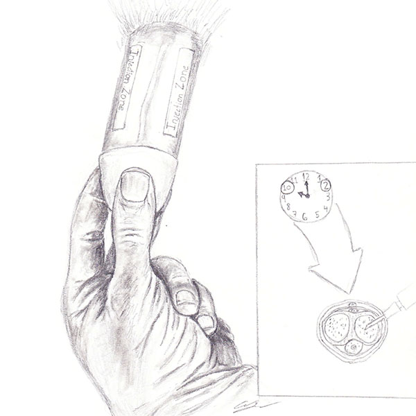 600x600 Severe Impotence Injection Therapy - Injection Drawing