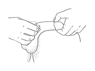 315x236 Trimix Injection Rev For Men - Injection Drawing