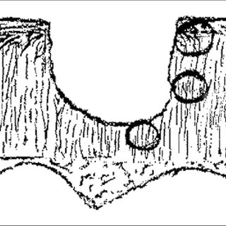 320x320 drawing depicting a partial thickness cartilage injury - Injury Drawing