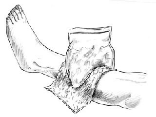 320x240 leg injuries in kids children's hospital colorado - Injury Drawing