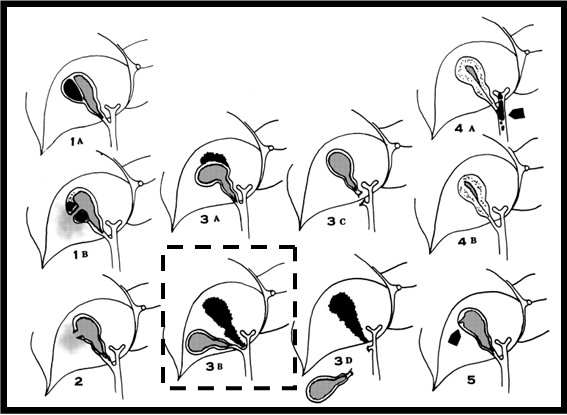 567x415 schematic drawing of all known types of gallbladder injury - Injury Drawing