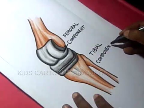480x360 how to draw knee joint replacement ptoceder drawing for kids - Joint Drawing