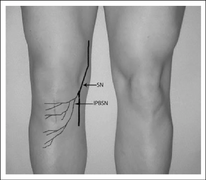 707x617 A Drawing Of The Sn And The Ipbsn On A Right Knee After Patellar - Knee Drawing