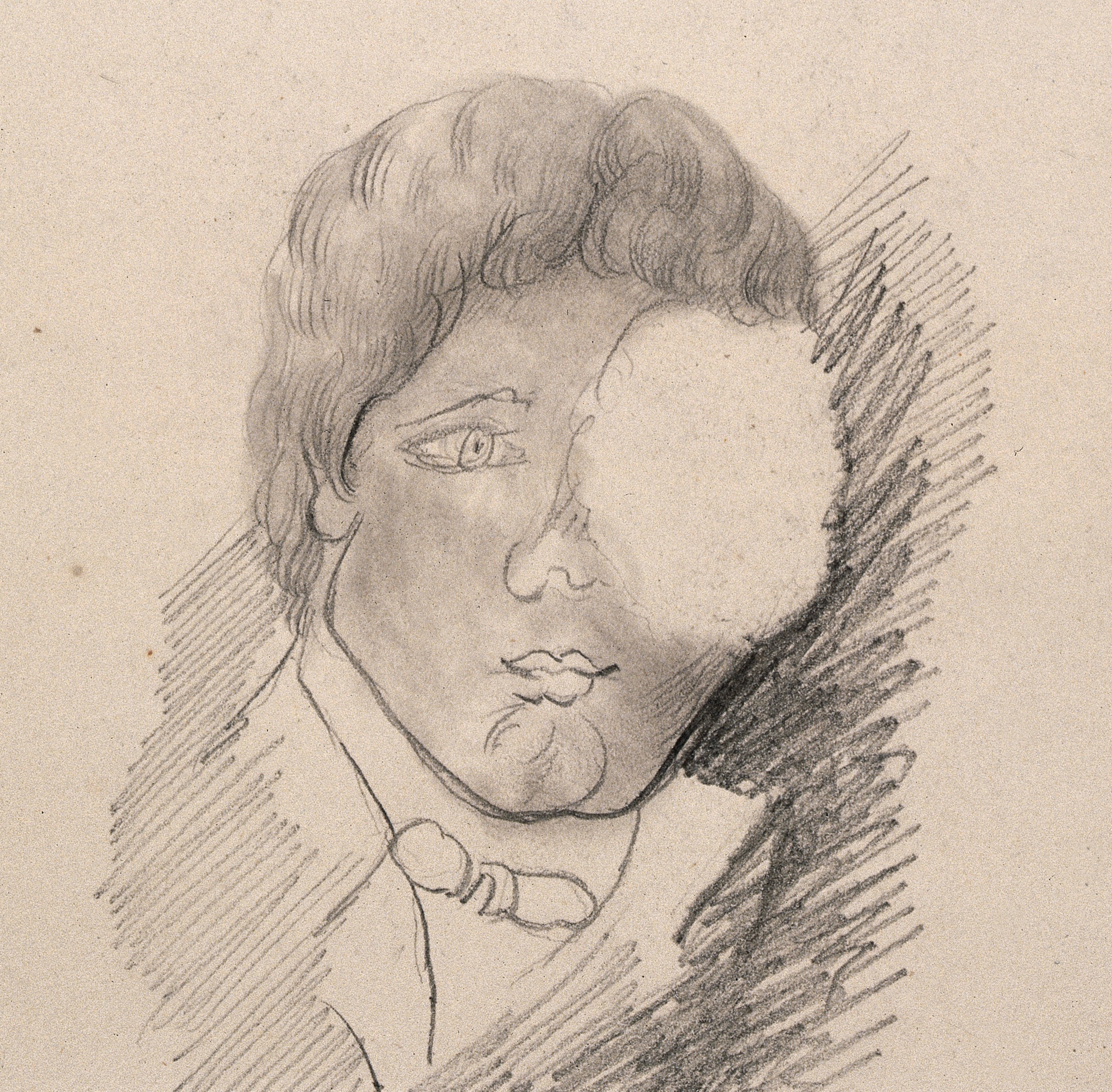 2910x2860 A Man's Face With A Swelling Over His Left Eye Drawing - Left Eye Drawing