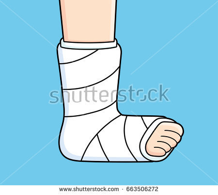 450x401 collection of free cast drawing gca download on ui ex - Leg Cast Drawing