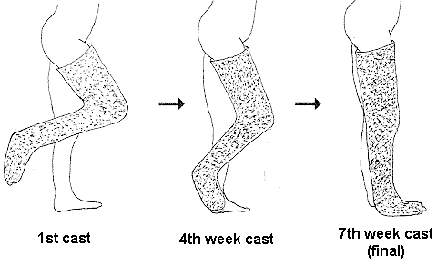 480x292 Muscle Contractures - Leg Cast Drawing
