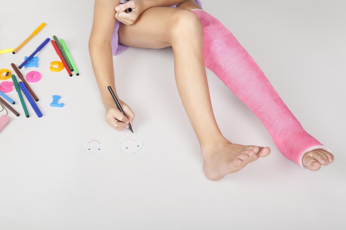 1100x734 buckle fractures risk factors and recovery - Leg Cast Drawing