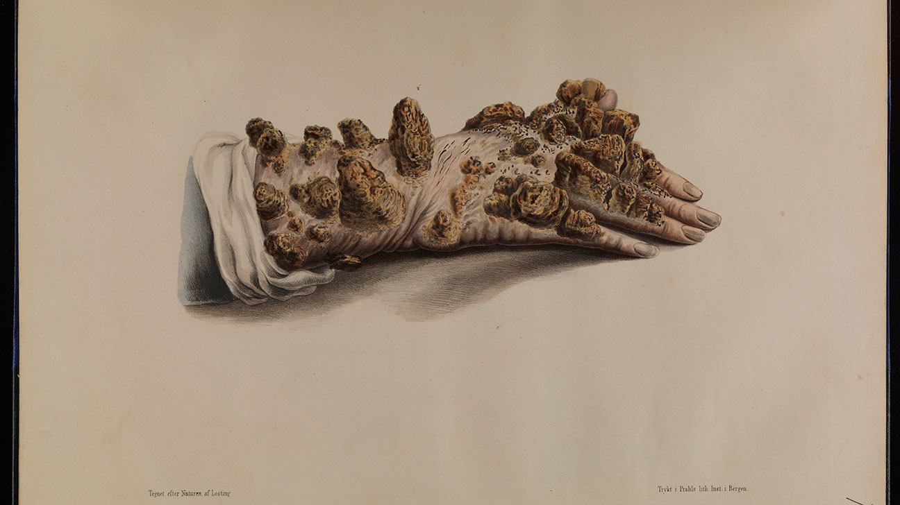 1296x728 leprosy symptoms, pictures, types, and treatment - Leprosy Drawing