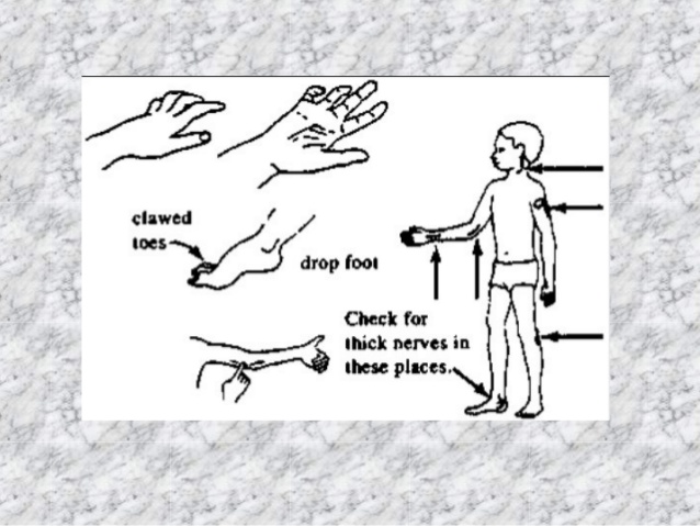 638x479 Leprosy - Leprosy Drawing