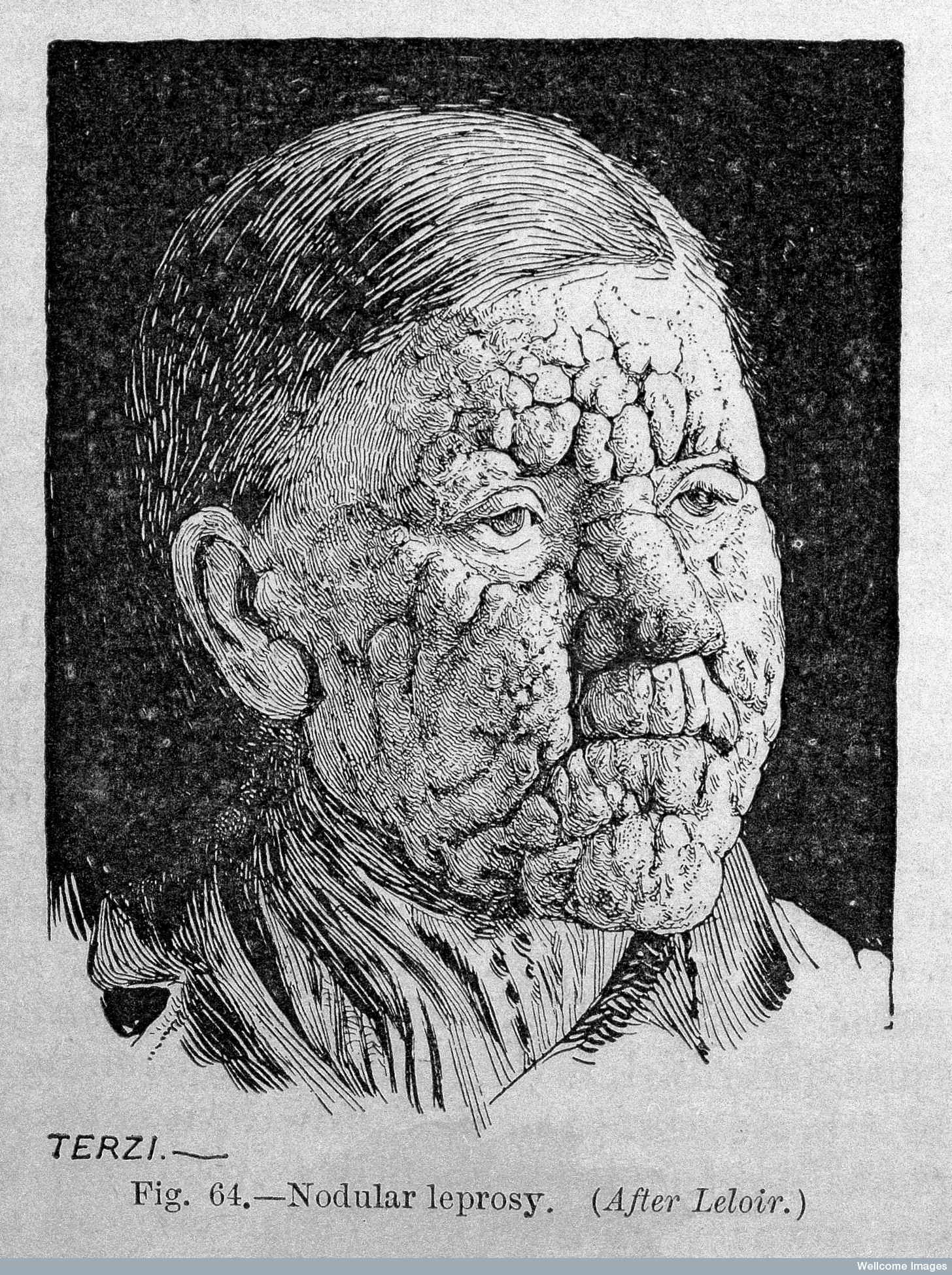 1456x1949 Photo - Leprosy Drawing