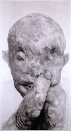 236x433  - Leprosy Drawing