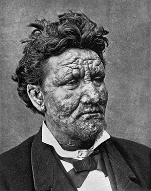 300x380 the hansen neisser controversy concerning the discovery - Leprosy Drawing