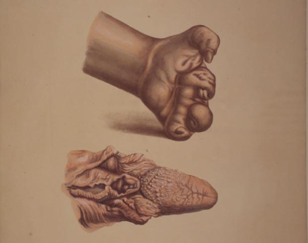 620x489 The Horrific Disease That Won't Die Sciencenordic - Leprosy Drawing