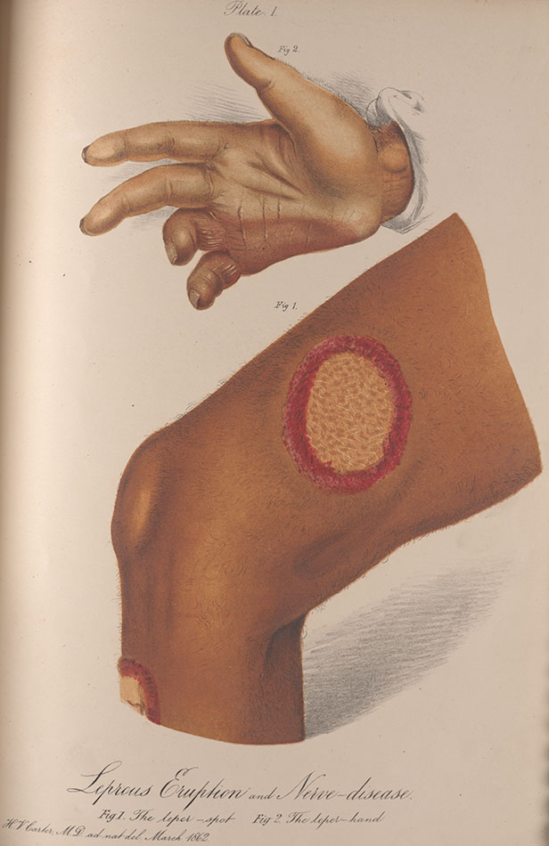 616x950 king's collections online exhibitions henry vandyke carter - Leprosy Drawing
