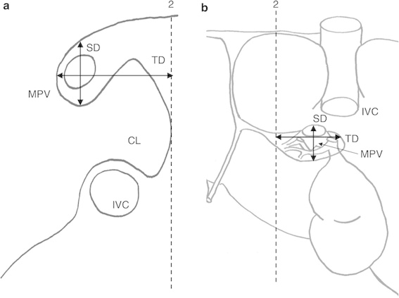 567x423 schematic drawing of liver, showing additional landmarks - Liver Drawing