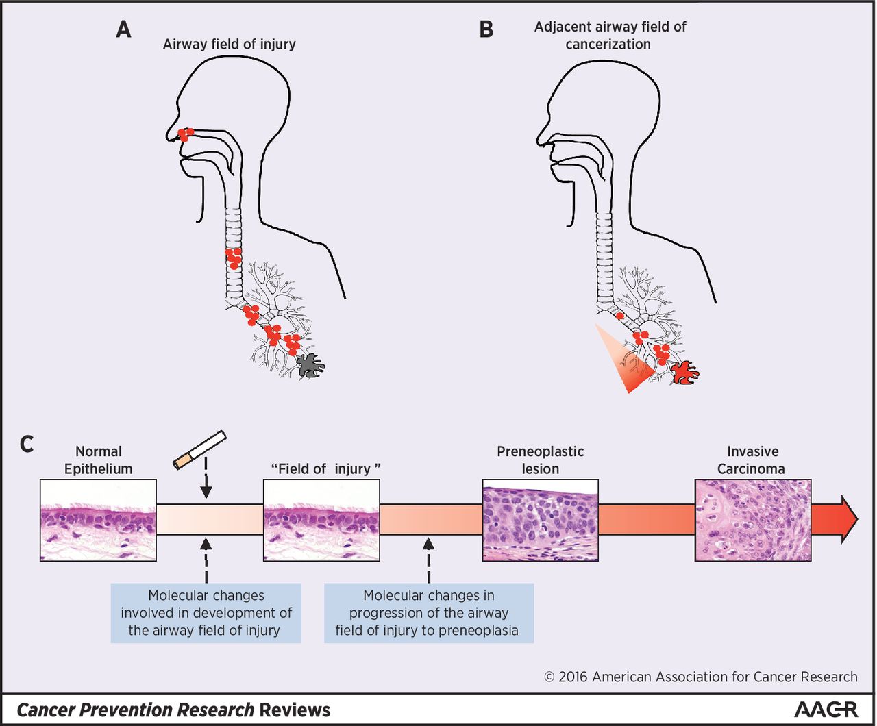 1280x1060 early events in the molecular pathogenesis of lung cancer cancer - Lung Cancer Drawing