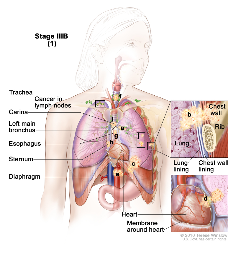 800x863 figure, stage iiib non small cell lung - Lung Cancer Drawing