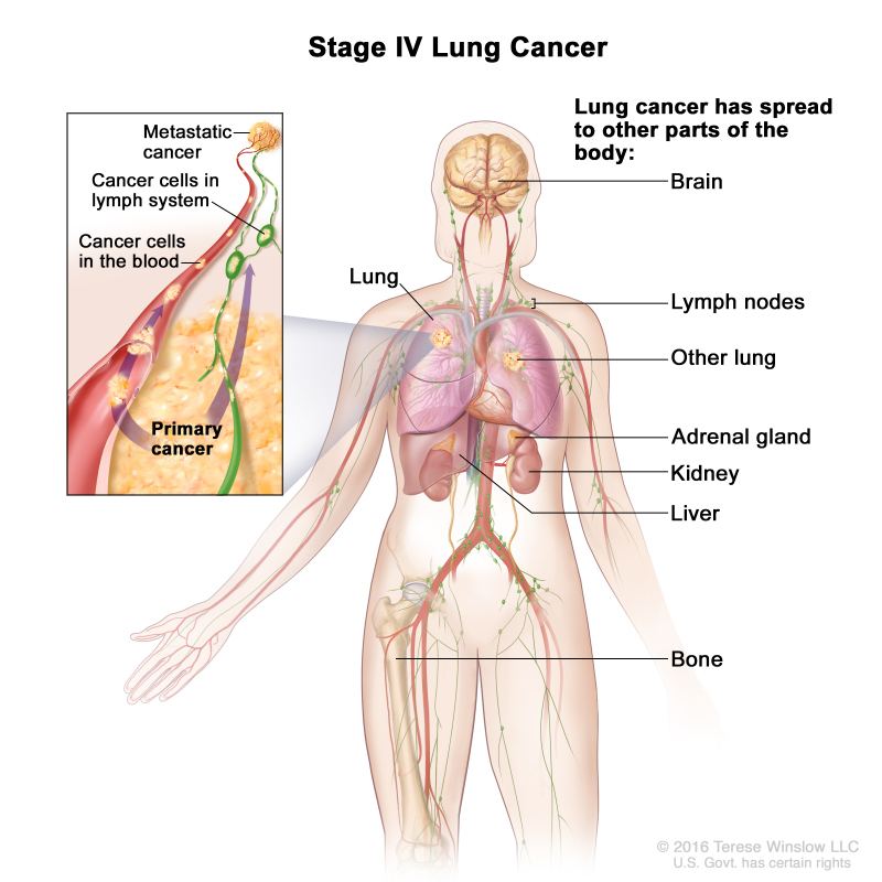 800x800 figure, stage iv non small cell lung - Lung Cancer Drawing