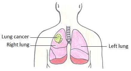 438x239 lung cancer - Lung Cancer Drawing