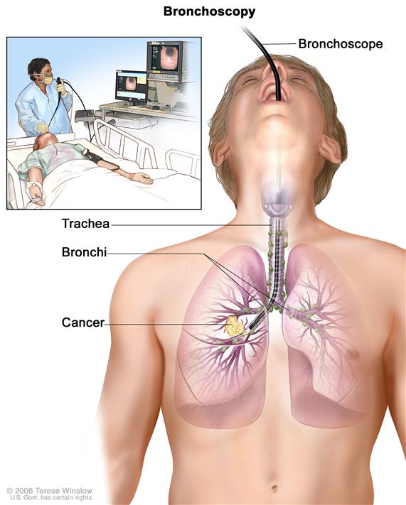 571x711 rare cancers australia - Lung Cancer Drawing
