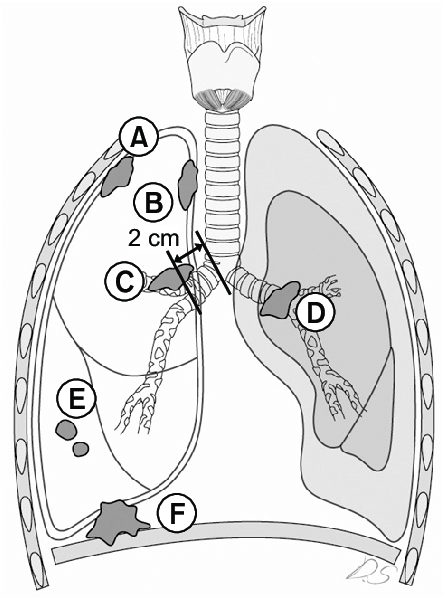 444x600 schematic illustration of non small cell lung cancer - Lung Cancer Drawing